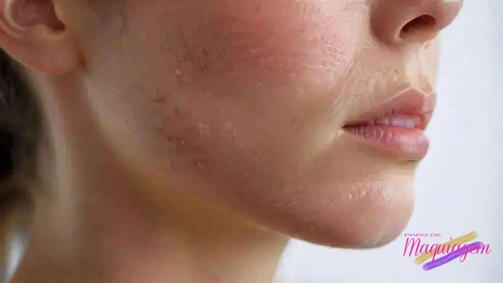 O que realmente causa acne hormonal? Entenda as 3 raízes do problema