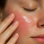 Sérum calmante para rosácea: descubra como aliviar sua pele agora